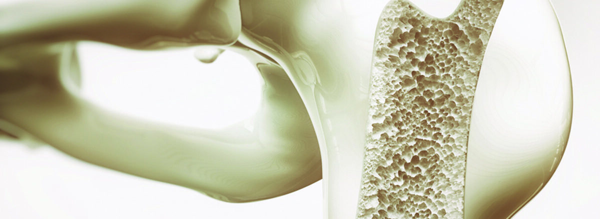 Kemik Erimesi (Osteoporoz)