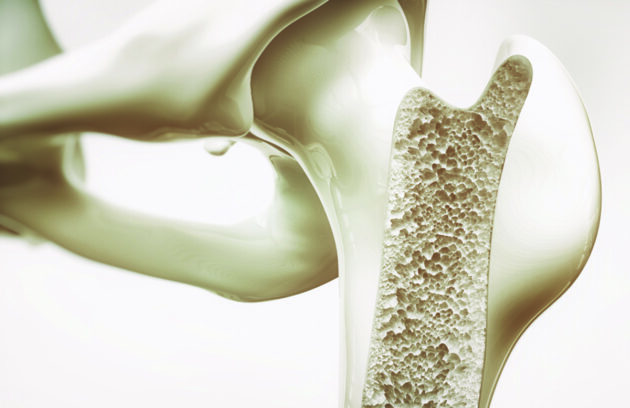 Kemik Erimesi (Osteoporoz)