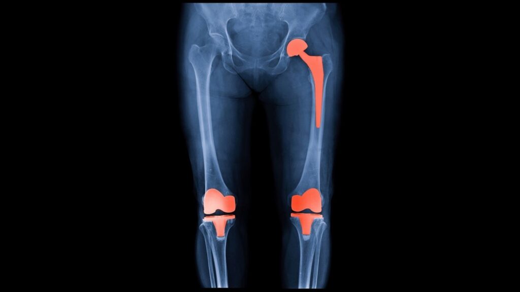 kalca-diz-problemleri
